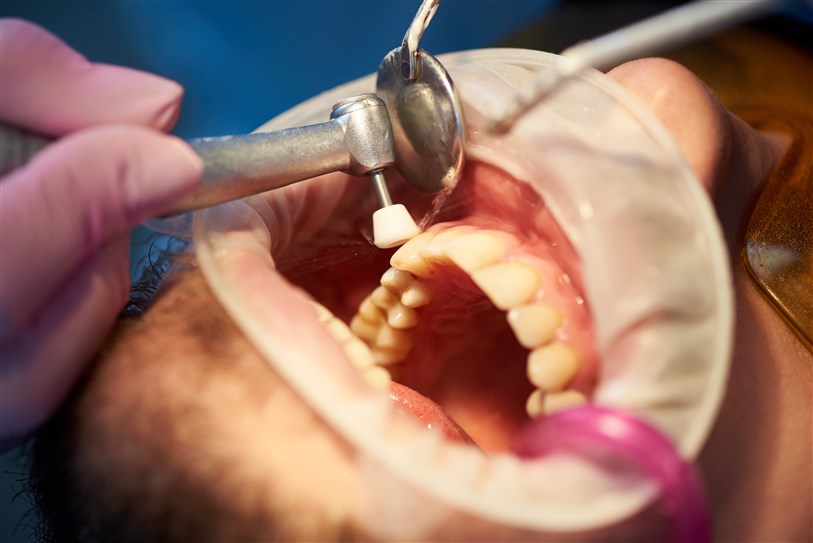 Dental Scaling and Polishing: A Complete Guide to Oral Health